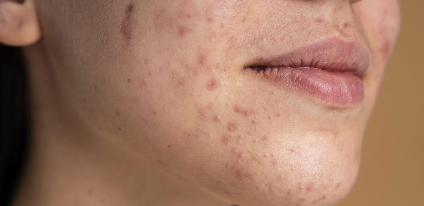 confident-young-woman-with-acne-close-up confident-young-woman-with-acne-close-up