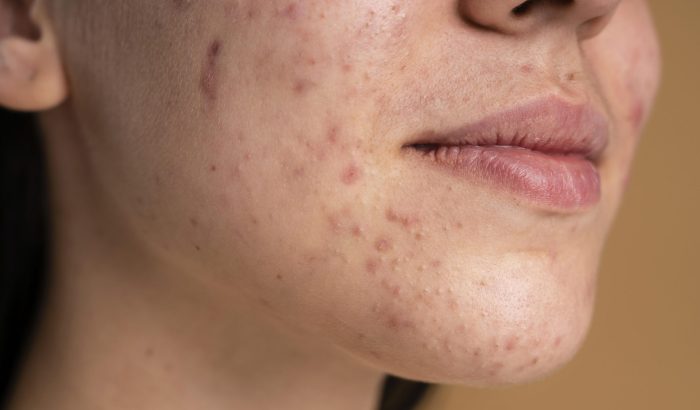 confident-young-woman-with-acne-close-up confident-young-woman-with-acne-close-up